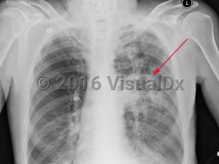 Imaging Studies image of Pulmonary nocardiosis - imageId=2955336. Click to open in gallery.  caption: 'Frontal chest x-ray with ill-defined cavitary opacity in the left upper lobe.'