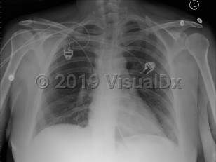 Imaging Studies image of Pulmonary embolism - imageId=2956045. Click to open in gallery.  caption: 'Frontal chest x-ray with no definite acute disease, most common finding on chest x-ray with pulmonary emboli.'