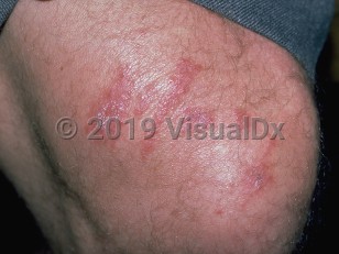 Clinical image of Coral injury