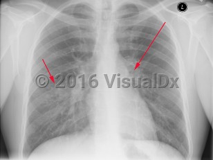Imaging Studies image of Tuberculosis - imageId=2958883. Click to open in gallery.  caption: 'Frontal chest x-ray with patchy consolidation in the lower lobes bilaterally, right greater than left, (short arrow).  There is also mediastinal adenopathy, (long arrow).'