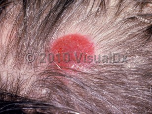 Clinical image of Alopecia neoplastica - imageId=2962452. Click to open in gallery.  caption: 'A bright red nodule with associated alopecia on the scalp.'