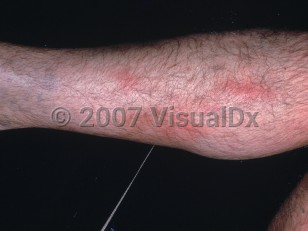 Clinical image of Superficial thrombophlebitis - imageId=2974016. Click to open in gallery.  caption: 'Linear erythematous patches on the leg.'