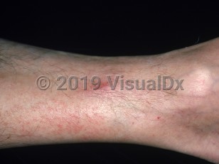 Clinical image of Phlebitis - imageId=2975541. Click to open in gallery.  caption: 'An erythematous patch near the ankle. Note the unrelated faintly erythematous papules and plaques of eczema, in the vicinity.'