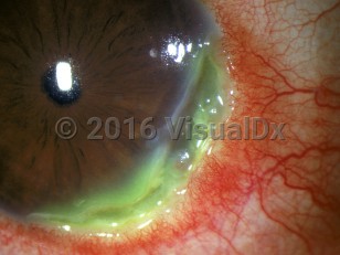 Clinical image of Marginal keratitis - imageId=2977593. Click to open in gallery. 