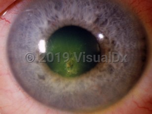 Clinical image of Corneal foreign body