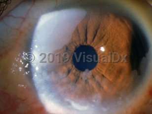 Clinical image of Corneoconjunctival squamous cell carcinoma - imageId=2989356. Click to open in gallery. 