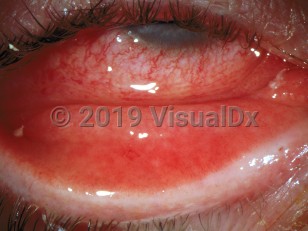 Clinical image of Allergic conjunctivitis - imageId=2991091. Click to open in gallery. 