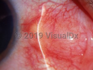 Clinical image of Nodular episcleritis