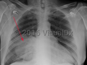 Imaging Studies image of Streptococcus pneumoniae pneumonia - imageId=2998207. Click to open in gallery.  caption: 'Frontal chest x-ray demonstrating a right middle lobe consolidation.'