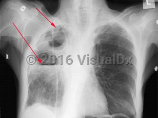 Imaging Studies image of Pseudomonas pneumonia