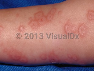 Clinical image of Erythema multiforme - imageId=30005. Click to open in gallery.  caption: 'Edematous and erythematous papules and plaques, some with a target-like appearance on the leg.'