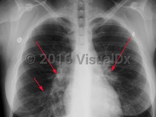 Imaging Studies image of Mycoplasma pneumonia
