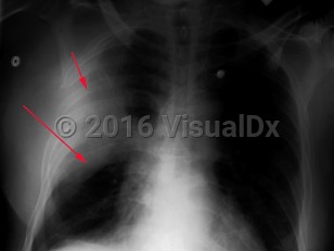 Imaging Studies image of Klebsiella pneumonia - imageId=3010271. Click to open in gallery.  caption: 'Frontal chest xray with homogeneous parenchymal consolidation of the right upper lobe, (short arrow).  There is downward displacement of the fissure related to lobar expansion, (long arrow), as seen with Klebsiella pneumonia.'