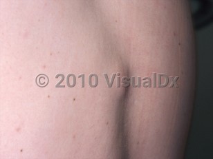 Clinical image of Lipoma - imageId=301128. Click to open in gallery.  caption: 'Flesh-colored and slightly pink nodule on the back.'