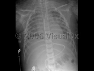 Imaging Studies image of Smoke inhalation - imageId=3014655. Click to open in gallery.  caption: 'Image from frontal chest x-ray in a child demonstrating bilateral, diffuse interstitial opacities, consistent with pulmonary edema. There is an endotracheal tube in the trachea, as well as an enteric tube extending into the duodenum.'