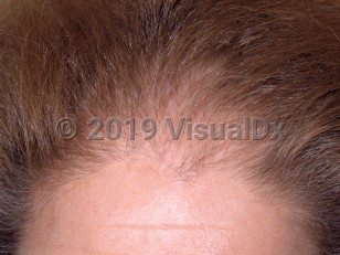 Clinical image of Female pattern alopecia - imageId=3016860. Click to open in gallery.  caption: 'Diffuse thinning of the hair on the frontal scalp with an intact frontal scalp line.'
