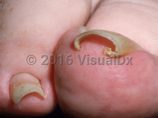 Clinical image of Pincer nail deformity
