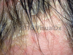 Clinical image of Pityriasis amiantacea - imageId=3022928. Click to open in gallery.  caption: 'Thick, adherent scales on the scalp and around the hair shafts.'