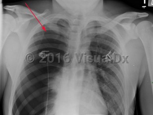 Imaging Studies image of Spontaneous pneumothorax - imageId=3028277. Click to open in gallery.  caption: 'Frontal chest x-ray with a large right pneumothorax with complete collapse of the right lung.'