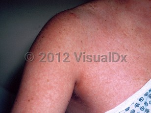 Clinical image of Measles - imageId=303754. Click to open in gallery.  caption: 'Widespread erythematous, confluent macules and patches on the chest and arm.'