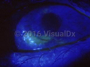 Clinical image of Trichiasis
