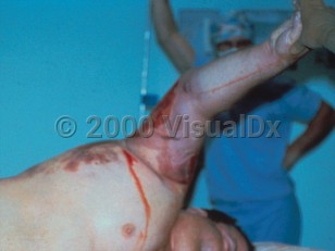 Clinical image of Gas gangrene - imageId=308081. Click to open in gallery. 