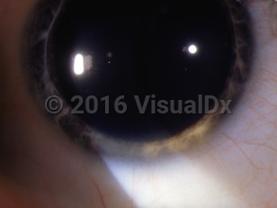 Clinical image of Wilson disease - imageId=3083243. Click to open in gallery. 