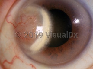 Clinical image of Interstitial keratitis - imageId=3095395. Click to open in gallery. 