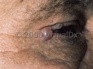 Clinical image of Eccrine hidrocystoma - imageId=309785. Click to open in gallery.  caption: 'A translucent papule at the lateral canthus and nearby acrochordons and seborrheic keratoses.'