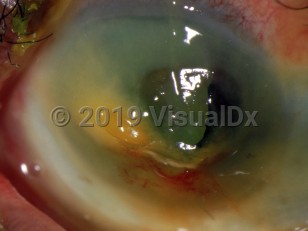 Clinical image of Corneal chemical burn - imageId=3098984. Click to open in gallery. 