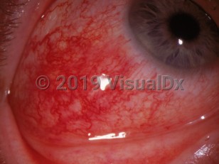 Clinical image of Diffuse scleritis - imageId=3103267. Click to open in gallery. 
