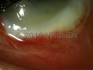Clinical image of Ocular alkali burn - imageId=3104316. Click to open in gallery. 