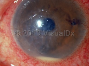 Clinical image of Bacterial corneal ulcer - imageId=3104703. Click to open in gallery. 