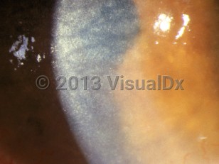 Clinical image of Cystinosis - imageId=3105948. Click to open in gallery. 