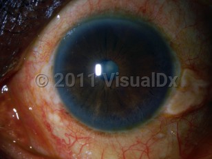 Clinical image of Cataracts - imageId=3114289. Click to open in gallery.  caption: 'A blue-white discoloration in the pupillary space.'
