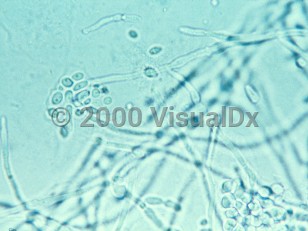 Lab image of Vulvovaginal candidiasis - imageId=311552. Click to open in gallery.  caption: 'A high-power view of yeasts and pseudohyphae.'