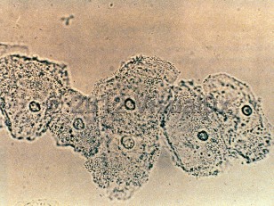 Lab image of Bacterial vaginosis - imageId=311617. Click to open in gallery.  caption: 'Clue cells seen on a wet mount.'