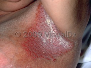 Clinical image of Hailey-Hailey disease - imageId=31267. Click to open in gallery.  caption: 'A well-demarcated, macerated, erythematous plaque with many linear and few tiny round erosions in the axilla.'