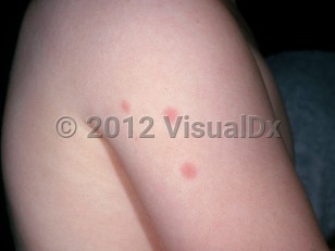 Clinical image of Bedbug bite - imageId=3133638. Click to open in gallery.  caption: 'Urticarial papules on the arm.'