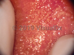Clinical image of Vestibular papillomatosis - imageId=313500. Click to open in gallery.  caption: 'A close-up of many tiny papules on the vulval mucosa.'