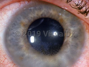 Clinical image of Uveitis