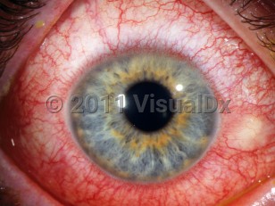 Clinical image of Toxic conjunctivitis