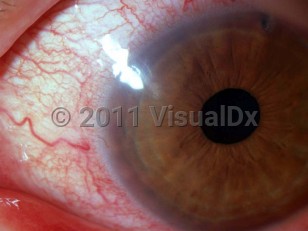 Clinical image of Contact lens solution toxicity - imageId=3144398. Click to open in gallery. 