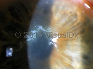 Clinical image of Herpes zoster ophthalmicus - imageId=3149677. Click to open in gallery.  caption: 'Pseudodendrites on the cornea.'