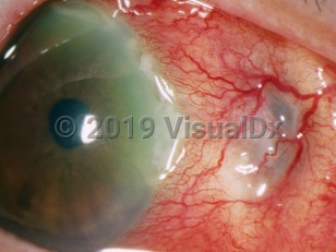 Clinical image of Necrotizing scleritis