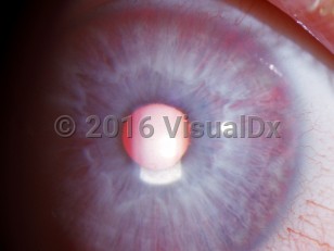 Clinical image of Ocular albinism