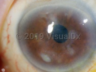 Clinical image of Ocular acid burn