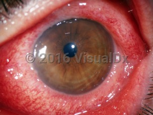 Clinical image of Gonococcal conjunctivitis - imageId=3193274. Click to open in gallery. 