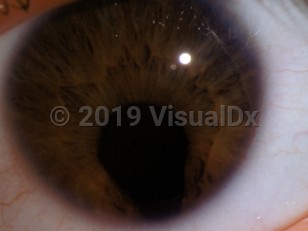 Clinical image of Coloboma