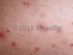 Clinical image of Folliculitis - imageId=320768. Click to open in gallery.  caption: 'A close-up of follicularly based papules and a pustule.'